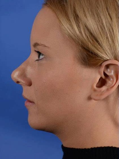 Patient Primary Rhinoplasty Before And After Photos Englewood