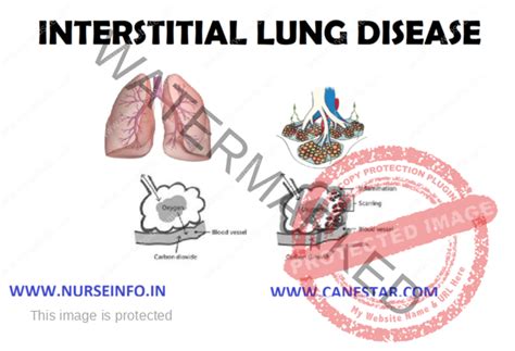 Interstitial Lung Disease Nurse Info