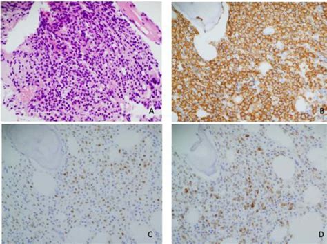 Bone Marrow Biopsy Showing Hypercellular Marrow With Diffuse Lymphoid