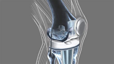 Components Of A Knee Prosthesis