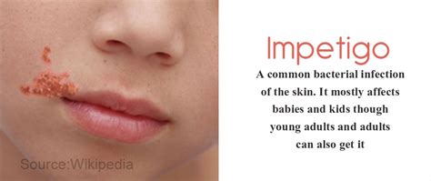 Impetigo Symptoms Causes Complications Diagnosis Treatment