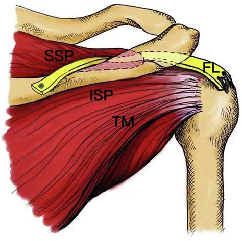 Supraspinatus Tendon Reconstruction Using Fascia Lata Autograft For Irreparable Posterosuperior