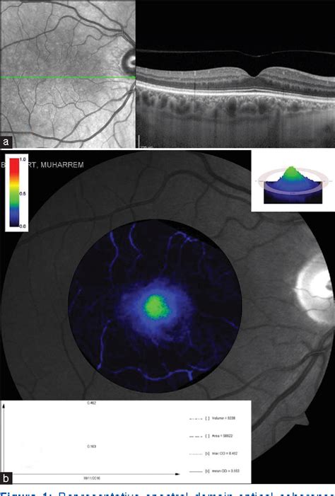 Figure 1 From Comparison Of Macular Pigment Optical Density In Patients