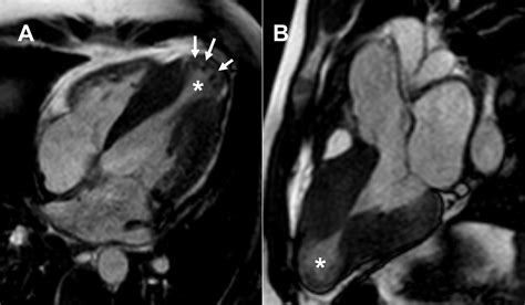 Role Of Cardiac Magnetic Resonance In The Diagnosis Of Infiltrative