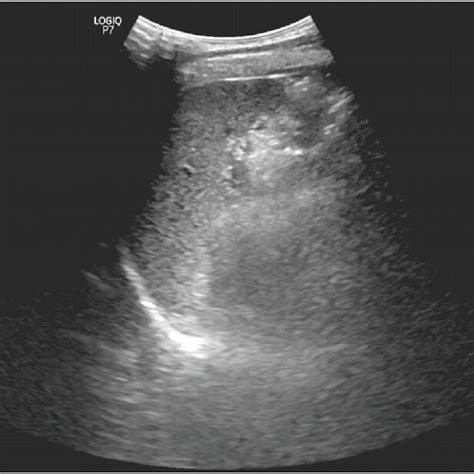 Ultrasound Spleen Image Obtained From A 21 Year Old Participant Download Scientific Diagram