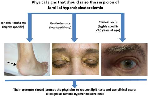 The Value Of Physical Signs In Identifying Patients With Familial