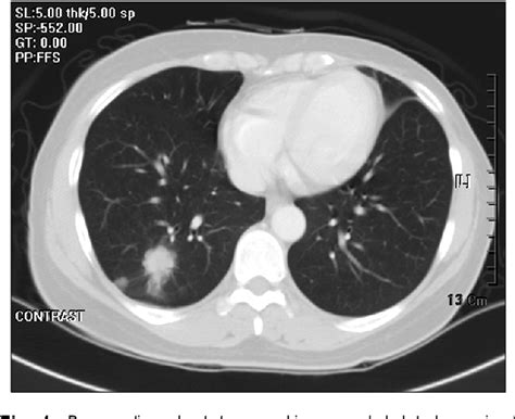 Figure 1 From Primary Pulmonary Carcinoma Ex Pleomorphic Adenoma Of The