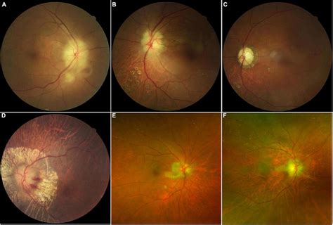 Color Fundus Photographs In Patients With Giant Cell Arteritis