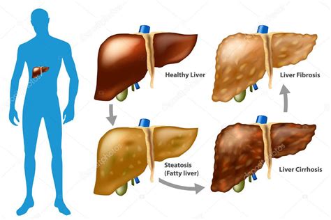 Hepatopatia Crônica E Cirrose BRAINCP