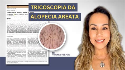 Tricoscopia Da Alopecia Areata Artigo Cient Fico Youtube