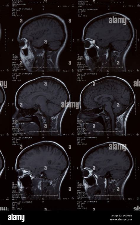 Mri Of Healthy Brain Hi Res Stock Photography And Images Alamy