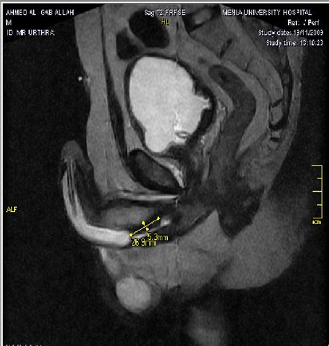 Magnetic Resonance Urethrography Versus Conventional Retrograde Urethrography For Diagnosis Of