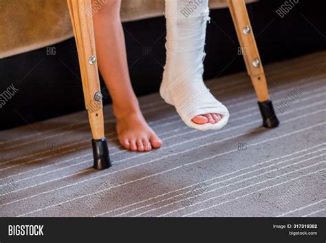 Broken Leg Cast Image & Photo (Free Trial) | Bigstock