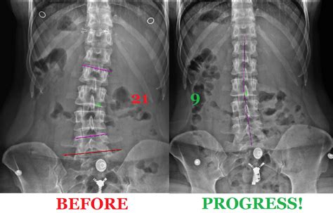 Digital Spine X-Rays