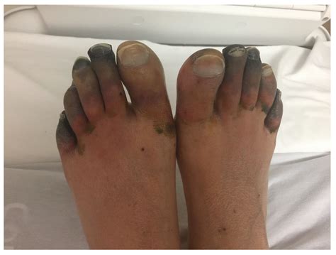 Medicina Free Full Text Symmetrical Peripheral Gangrene Associated