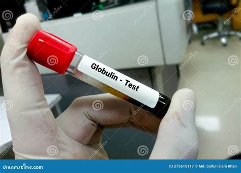 Globulin Test, Diagnosis of Liver Disease. Stock Image - Image of care ...