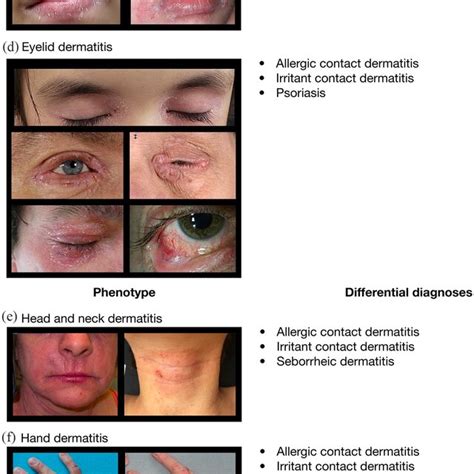 Most Common Phenotypes Of Hand Eczema Dyshidrotic And Download