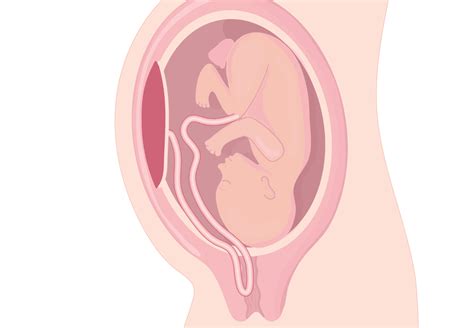 O Que Prolapso De Cord O Umbilical Fetalmed