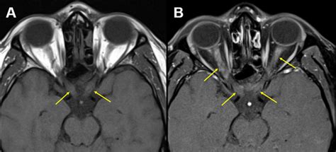 Neuromyelitis Optica Spectrum Disorder And Mogad Optic Neuritis A Teaching Case Series The