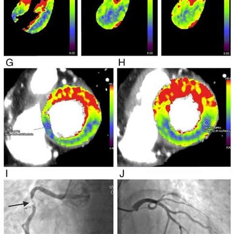 Myocardial Perfusion Imaging And Invasive Coronary Angiography Ct