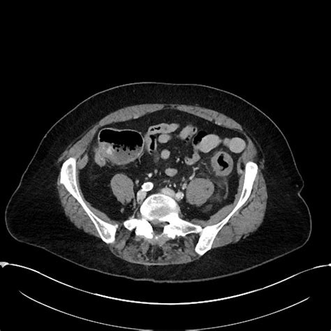 Radiopaedia Case Ischemic Colitis Id 59528 Study 66912 NC Commons