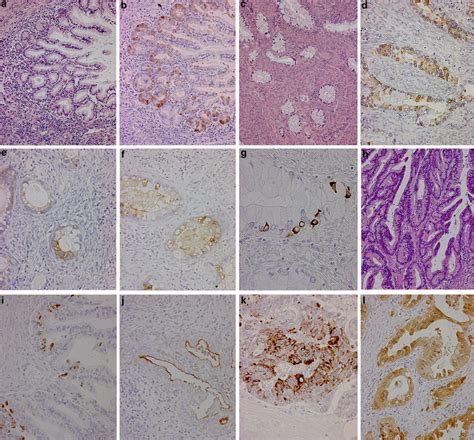 Gastrointestinal Immunophenotype In Adenocarcinomas Of The Uterine