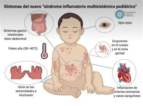 Síndrome inflamatorio multisistémico pediátrico Papis por primera vez