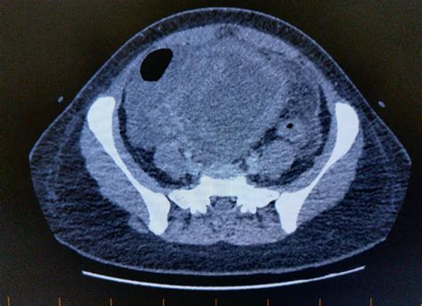 Ct Report Of The Abdomen And Pelvis Large Pelvic Mass Which May Be