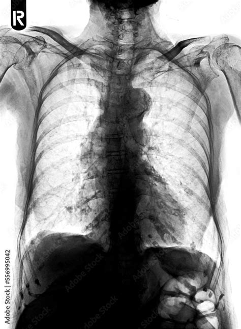 Film Chest X Ray Show Alveolar Infiltrate At Left Middle Lung Foto De