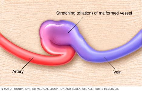 Arteriovenous fistula - Symptoms and causes - Mayo Clinic