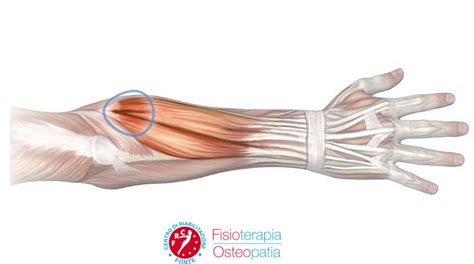 Tendiniti Al Braccio Conoscere Cause E Rimedi Centro Di