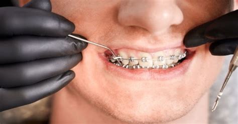 Lastiques En Orthodontie Avec Appareil Dentaire Ou Goutti Res