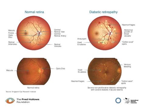 Diabetes Eye Health Guide