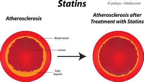 Cholesterinsenker Statine