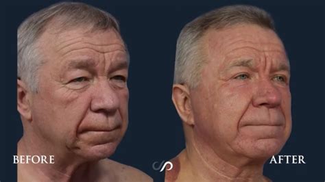 Facial Rejuvenation On A 65 Year Old Male Before And After Los