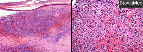 Kaposi Sarcoma Skin Cancer Tabitomo