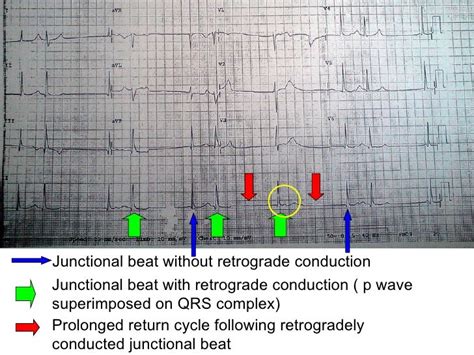 ECG: Junctional Escape Rhythm