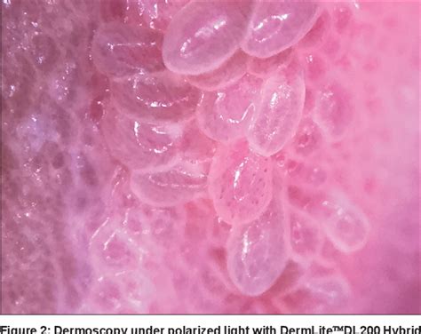 Figure 2 From Importance Of Dermoscopy To Diagnose Vulvar Vestibular Papillomatosis Vs Warts