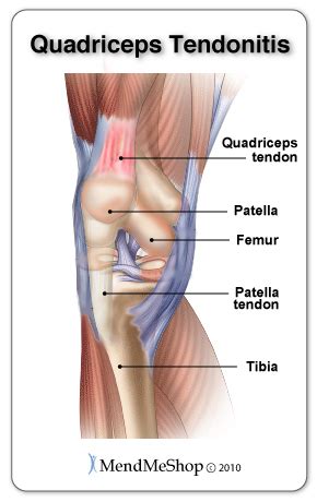 Quadriceps Tendonitis