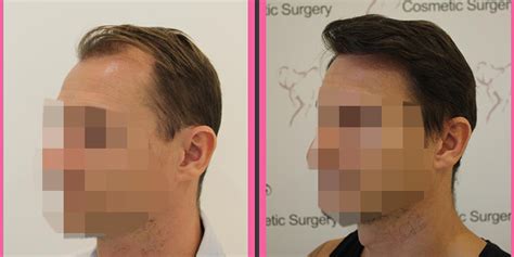 Hair Transplant In Dubai Uae Dubai Cosmetic Surgery Clinic