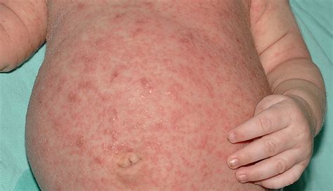 Scabies Rash On Back