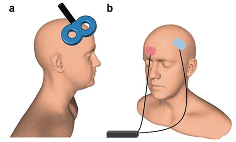 O Que Neuromodula O Cerebral N O Invasiva