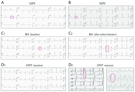 Electrocardiographic Findings In The Four Primary Electrical Disorders