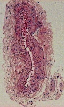 Carotid Artery Ligation