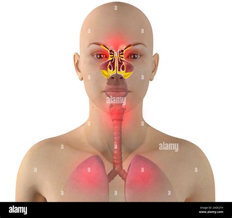 Sinus Infection Or Sinusitis Computer Illustration The Sinuses Are Membrane Lined Air Filled