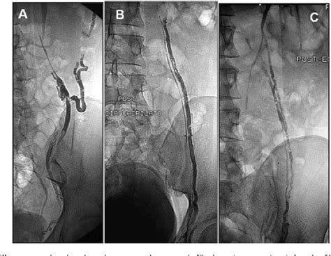 Embolization Of Varicocele Semantic Scholar