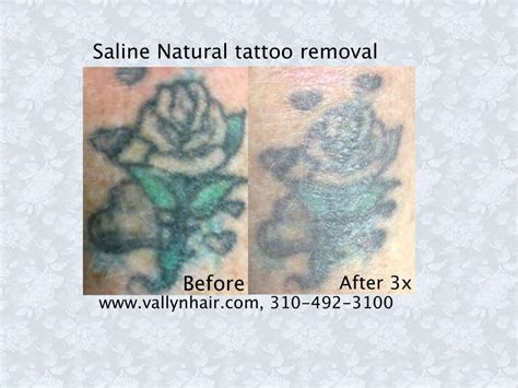 Natural Tattoo Removal Natural Tattoo Removal Tattoo Removal Diy Tattoo