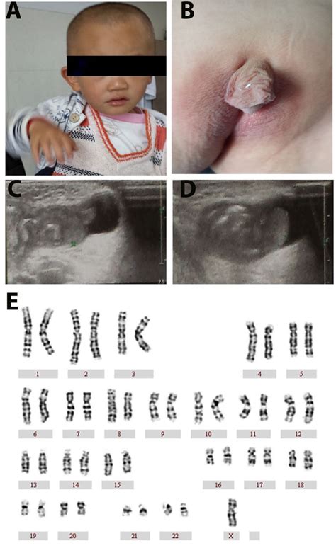 A Novel Sex Chromosome Mosaicism X Y Xy Yy Xyy Causing