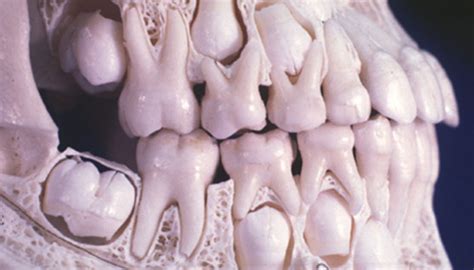 Um pouco de Odonto Cronologia de Erupção Dentes Decíduos e Permanentes