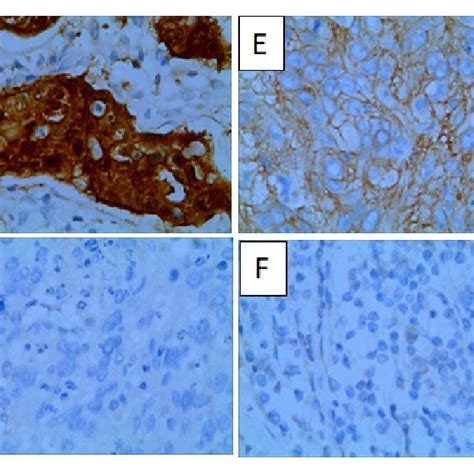 Ang 1 Ang 2 And Vegf Expression In Cervical Cancer A Ang 1 Positive Download Scientific